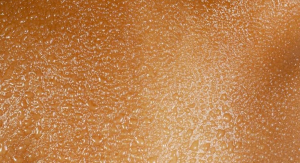 Psoriasis: especialista aclara que la enfermedad de la piel no es contagiosa y pide eliminar los estigmas sociales - Canal 12 de El Salvador