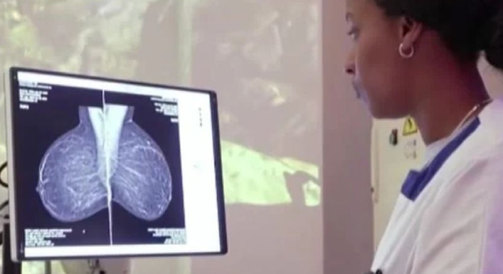 Nuevo modelo de inteligencia artificial detecta metástasis de cáncer de mama en ganglios de la axila